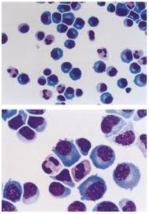 Lymphocytic pleocytosis