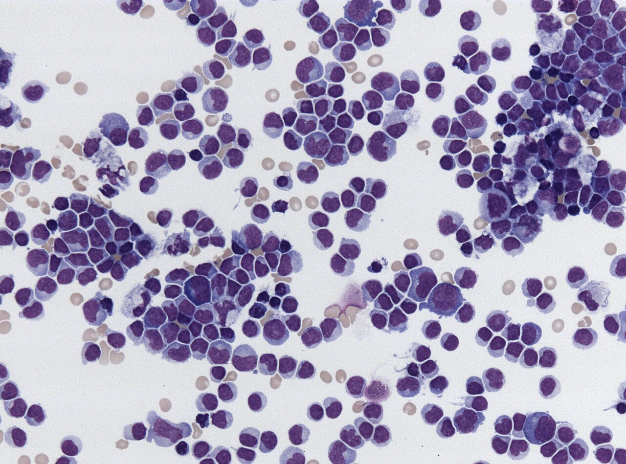 Lymphocytic pleocytosis